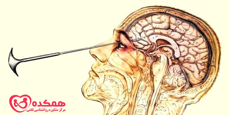 لوبوتومی چیست؟
